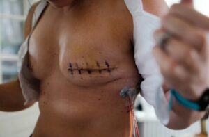 nipple surgery